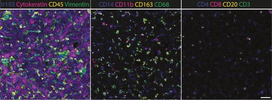 Myeloïde immuuncellen zijn veel aanwezig in hepatoblastoom  
Met een speciale beeldtechniek (imaging mass cytometry) hebben we immuuncellen zichtbaar gemaakt in hepatoblastoom weefsel. Links ziet u een overzicht van de structuur van de tumor, waarbij de immuuncellen geel gekleurd zijn (CD45). In het midden is te zien dat er veel myeloïde cellen aanwezig zijn in de tumor. Rechts ziet u dat T-cellen (CD3 - groen) daarentegen bijna helemaal ontbreken.