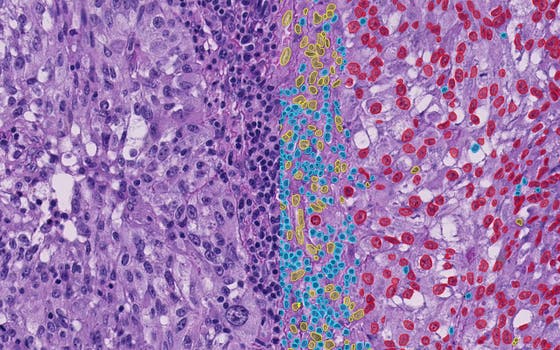 Biopsie van een melanoom met resultaten van het AI-model. In rood zijn tumorcellen, in blauw TIL's en in geel niet-tumorcellen en niet-TIL's weergegeven.