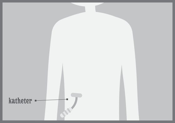 tekening van een katheter in de buik