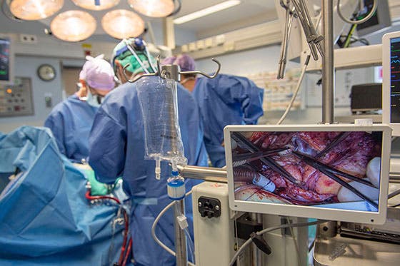 Chirurgen voeren een complexe hartoperatie uit, met een scherm op de voorgrond dat een close-up van de ingreep toont in een goed uitgeruste operatiekamer