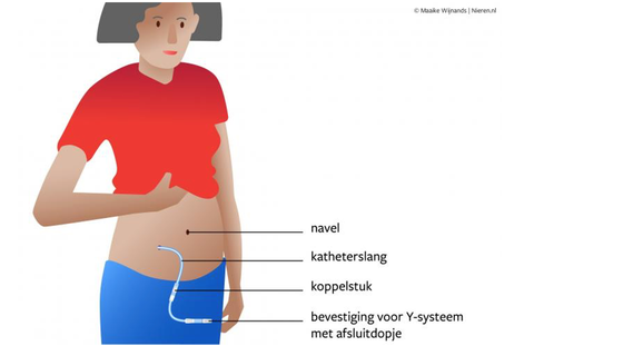 Een persoon met een buikdialyse-katheter in de buik