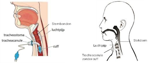 Tekeningen van tracheacanules met en zonder cuff