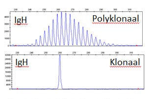 Voorbeeld van een B-cel klonaliteitsanalyse.